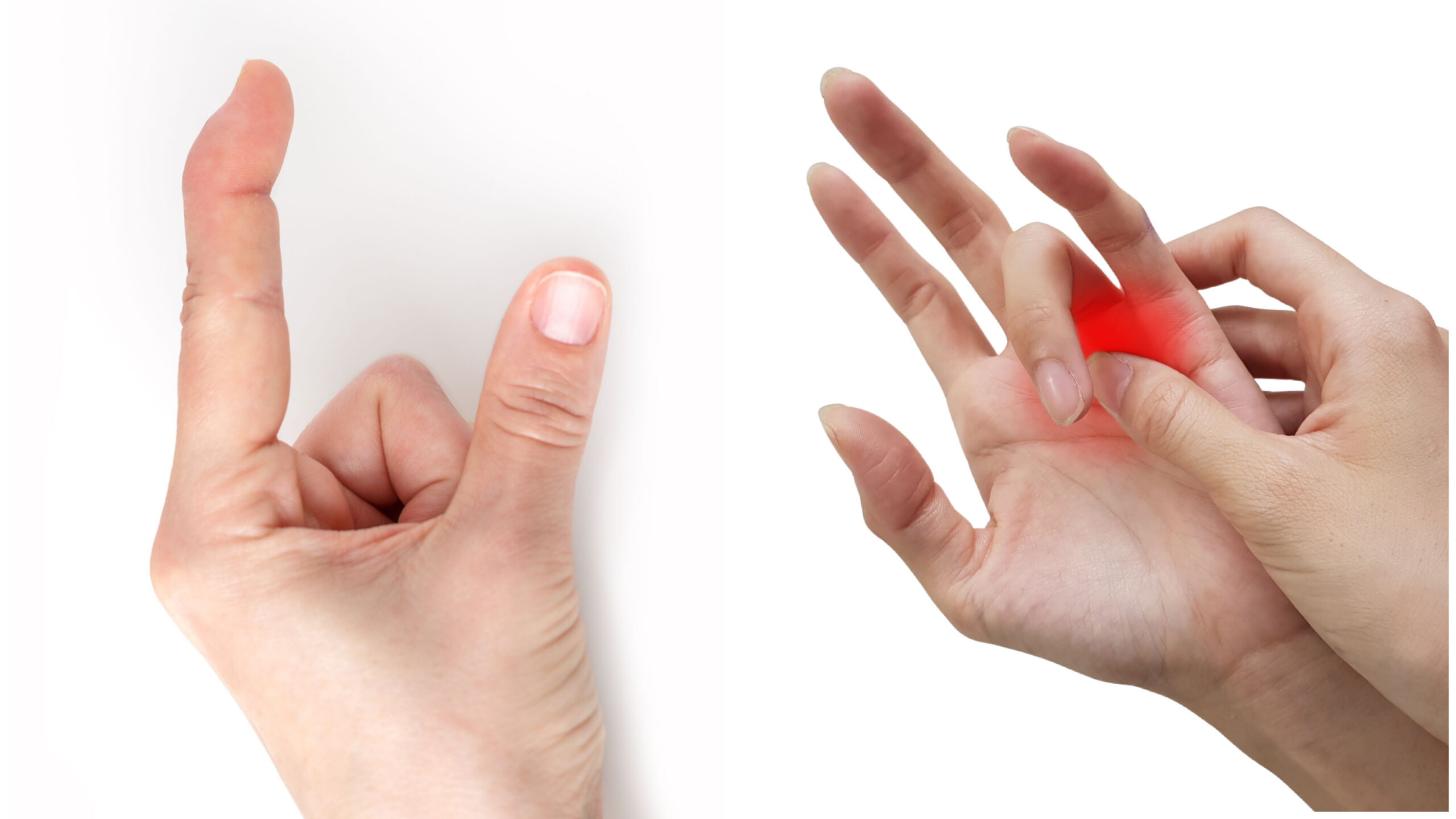 Using a Finger Splint to Treat Trigger Finger-Updated January 2024